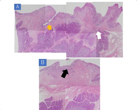 Histopathological Findings A B The Cbd And Pancreatic Duct Were