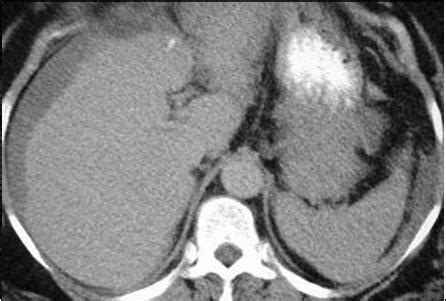 Learningradiology Acute Abdominal Emergencies