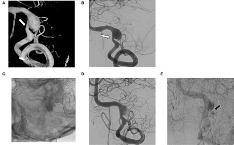 Frontiers Flow Diverter In Unruptured Intracranial Vertebral Artery