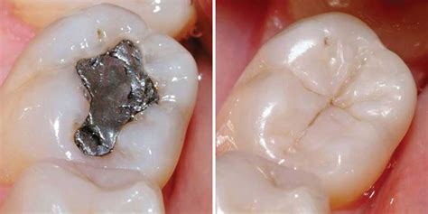 Amalgam Fillings? Your LA Dentist Recommends Going Metal-Free | Downtown Los Angeles Dentist ...