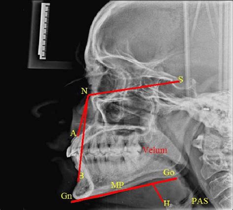 Lateral Cephalometric Radiograph Showing The Cervico Craniofacial