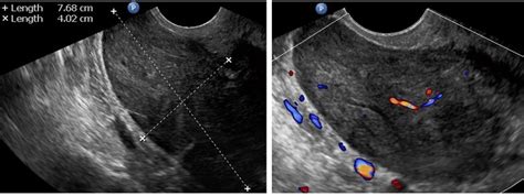 Figure A4 Transvaginal Ultrasonogram Of The Uterine Lesion Atypical