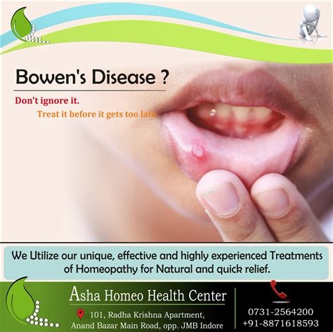 Behcet Disease Asha Homeo Health Center Indore