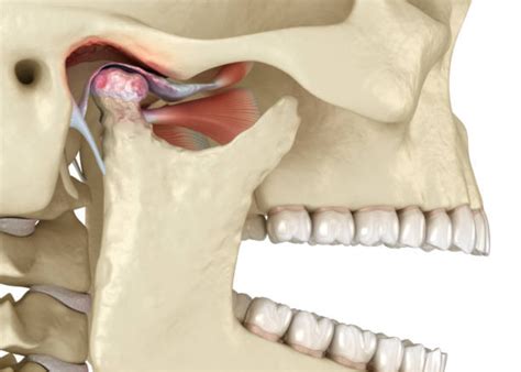 Trastornos de la articulación temporo mandibular hiperlaxitud