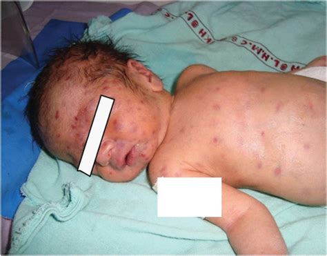 Congenital Toxoplasmosis Rash