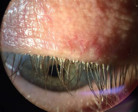 What Is Blepharitis And Meibomitis Blephex Treatment Glen Allen Va