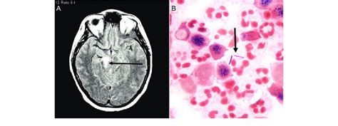 Listeria Monocytogenes Meningoencephalitis 3 Months After Renal