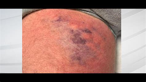 Alabama Man Hospitalized With Flesh Eating Bacteria After Kayaking In