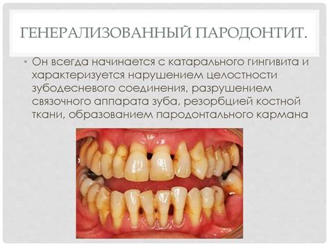 Пародонтит. Клиническая картина - презентация онлайн