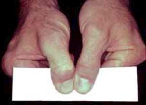 Froment’s Sign and Jeanne's Sign in Ulnar Palsy | HandLab Resources