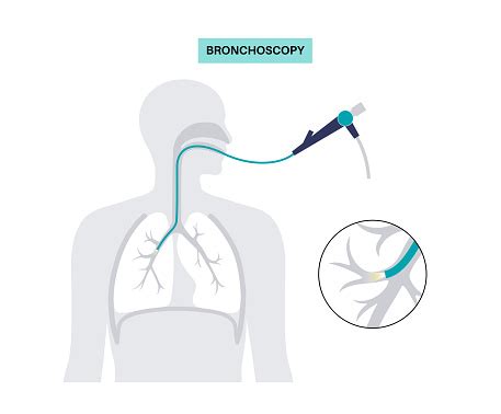 Bronchoscopy Procedure Concept Stock Illustration - Download Image Now ...