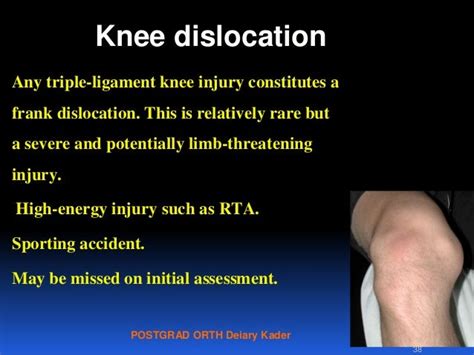 Pcl Plc Knee Dislocation