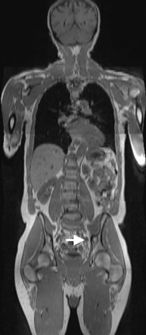 Imaging Diagnosis And Follow Up Of Advanced Prostate Cancer Clinical