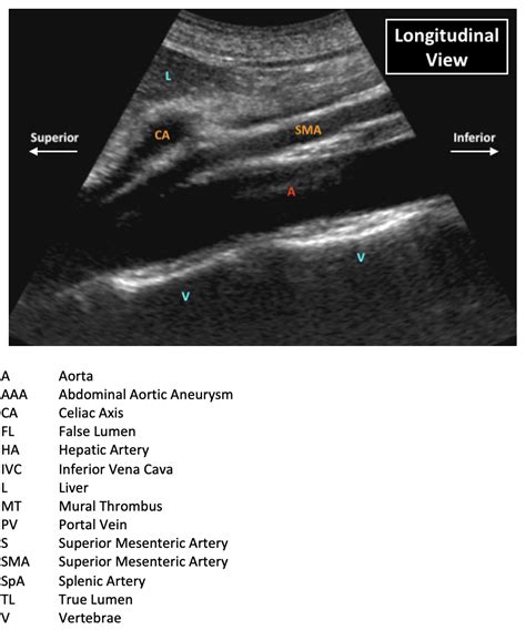 Ultrasound Of The Abdominal Aorta Emcyclopedia