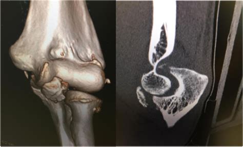 Anteromedial Coronoid Fractures Technical Description Of An Extensile Surgical Approach And