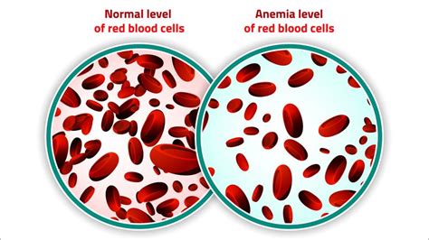 EU Panel Backs First Gene Therapy for Beta Thalassemia | Faculty of ...