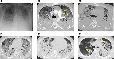 Respiratory Follow Up Of Patients With COVID 19 Pneumonia Thorax