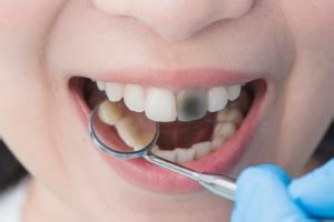 Qué es la necrosis dental y soluciones Clínica Dental en Toledo