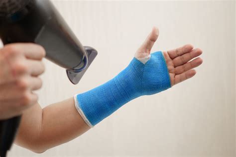 Everything You Need To Know About Arm Casts