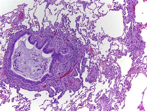 Asthmatic Granulomatosis The Small Airways Are Occluded By Large Mucus