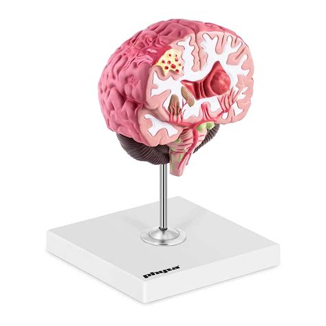 Physa Maquette Modèle Anatomique Des Pathologies Cérébrales Cerveau