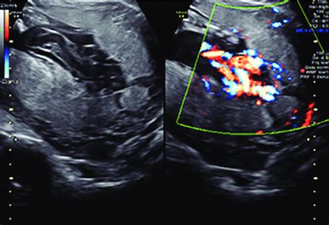 High Definition Color Flow Doppler Imaging Showing Bilobed Placenta Download Scientific Diagram