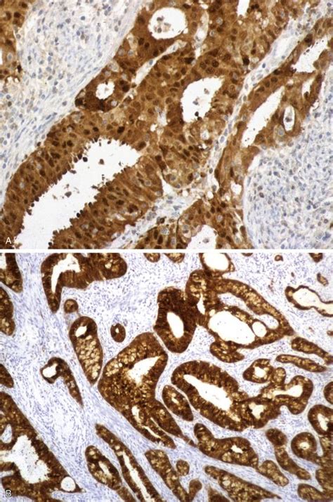 Immunohistochemistry And Molecular Diagnostics In The Differential