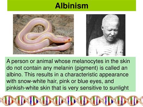 Types Of Albinism Chart