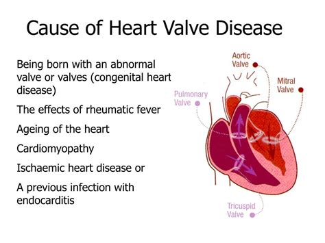 Ppt Aortic Valve Disease Powerpoint Presentation Free Download Id391667