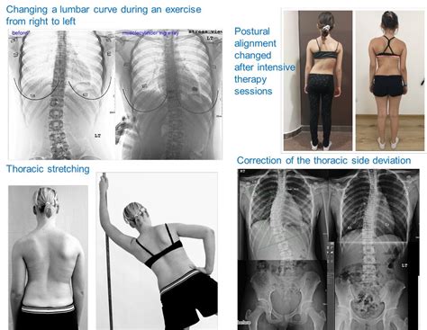 Isst Schroth International Schroth Three Dimensional Scoliosis Therapy