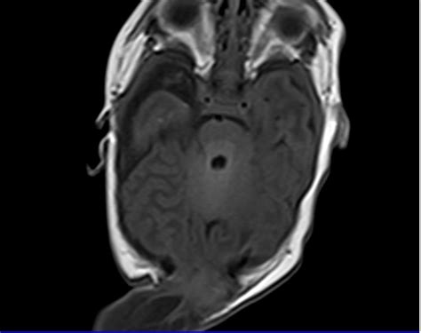 Meningoencephalocele MRI