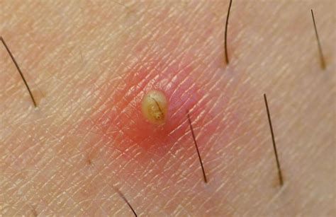 What Causes Ingrown Hair On Head