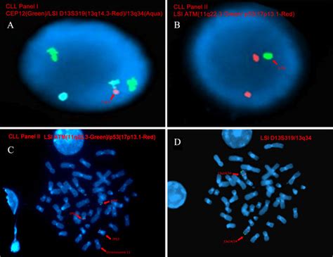 Interphase And Sequential Metaphase FISH In Our Patients Peripheral