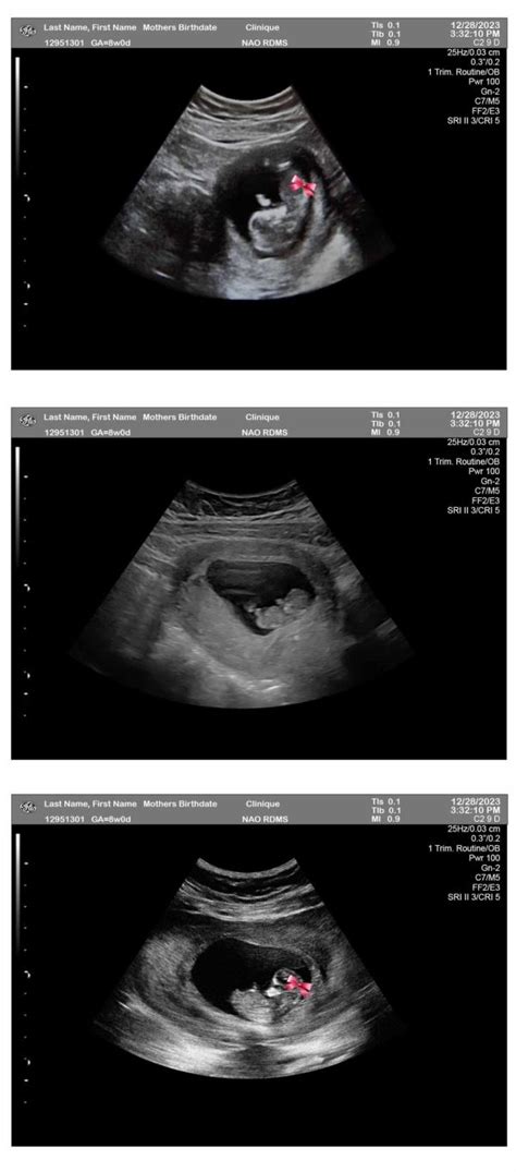 Weeks Ultrasound Bow Fetuses Ultrasounds