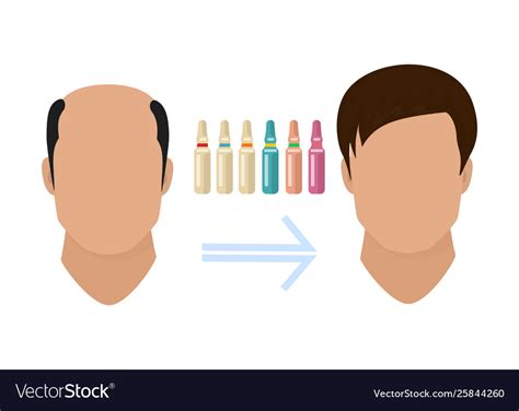 Male Hair Loss Treatment Before And After Stages Vector Image