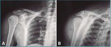 Luxación glenohumeral posterior aguda con gran inestabilidad