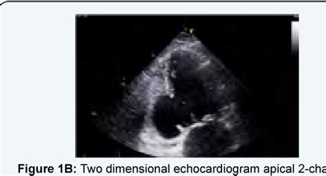 Figure 1 From Concomitant Left Ventricular Aneurysm And Ventricular