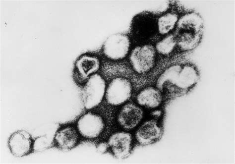 [figure Transmission Electron Micrograph Of Rubella ] Statpearls Ncbi Bookshelf