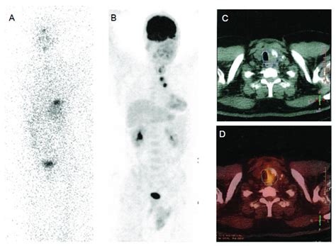 Papillary Thyroid Cancer In A 30 Year Old Woman Post Therapy A 131 I