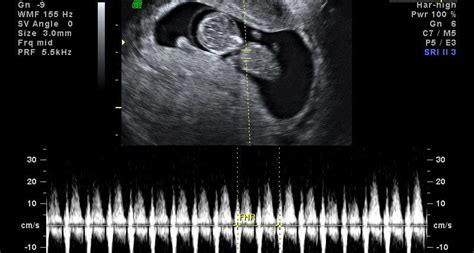 Ecografia De 3 Meses Soothwos