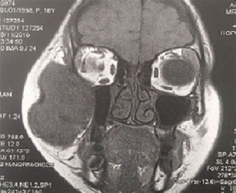 Mri Showing Voluminous Encapsulated Tissue Mass In Isosignal T1 In The Download Scientific