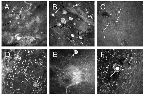 Acanthamoeba Keratitis Confocal