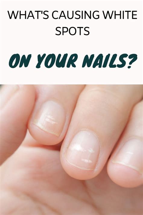 White Spots On Nails White Spots Under Nails White Dots On Nails White Marks On Nails White