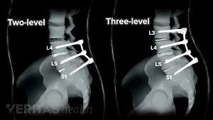 Multilevel Spinal Fusion for Low Back Pain | Spine-health