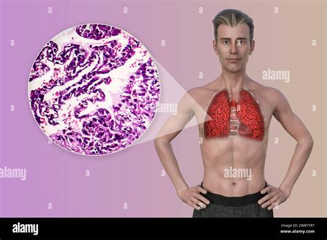 Man With Smoker S Lungs Illustration Stock Photo Alamy