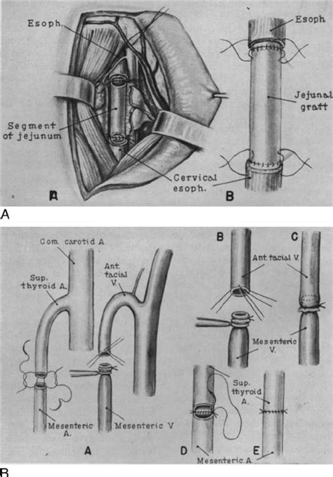 The First Clinical ‘‘free Tissue Transfer The Autotransplantation Of