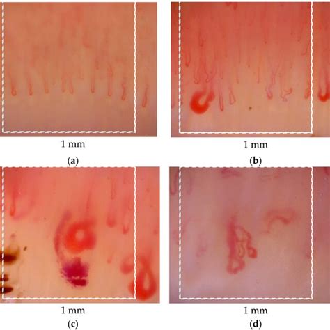 Nailfold Videocapillaroscopic Patterns Of Microangiopathy