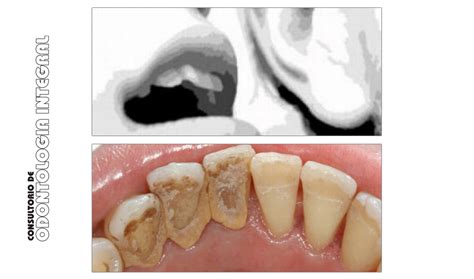 Blog de Odontología Cómo combatir la halitosis I