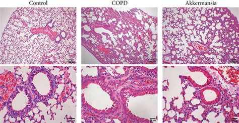 Akkermansia Muciniphila Improves Lung Tissue Injury And Autophagy In