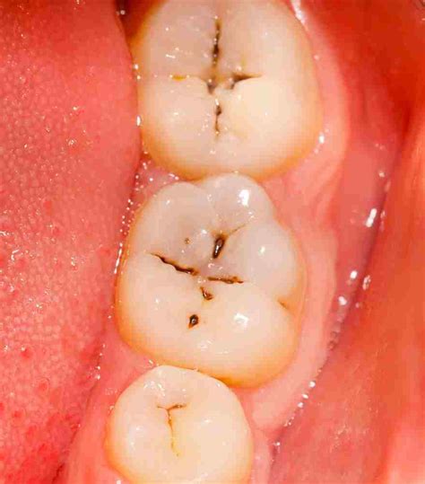 Qué Es La Caries Dental Y Cómo Prevenirla Ed Barcelona